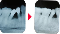 歯周病の歯科治療例　レントゲン画像