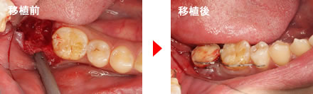 歯の移植前と後の写真