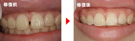 隙間のある歯の修復前と後の写真