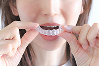 マウスピース矯正