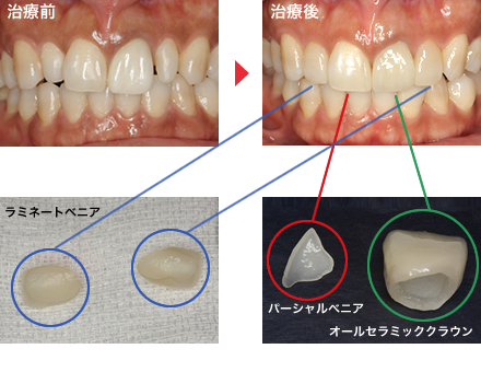 守口市の新井歯科の症例紹介・ホワイトニング（ラミネートべニア）