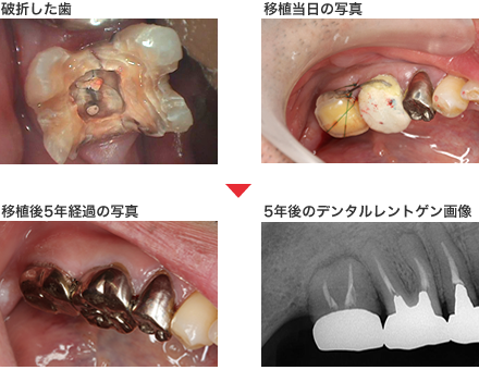 守口市の新井歯科の歯牙移植治療症例紹介1