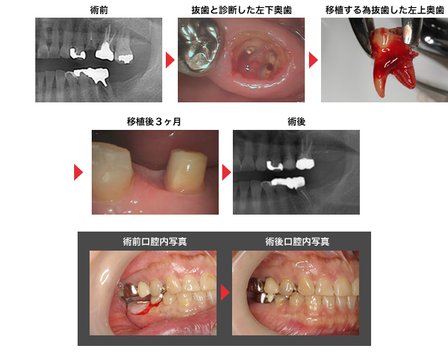 守口市の新井歯科の歯牙移植治療症例紹介2