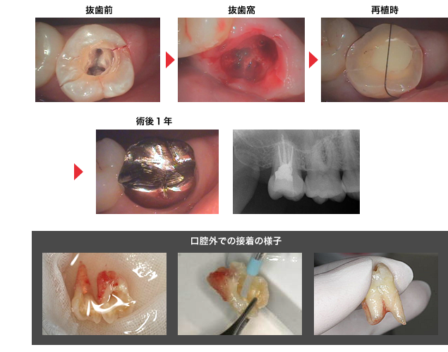 守口市の新井歯科の歯牙移植治療症例紹介3