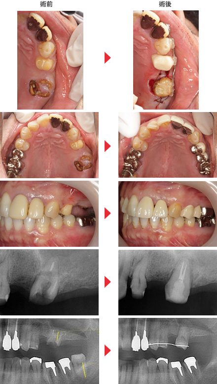 守口市の新井歯科の歯牙移植治療症例紹介4