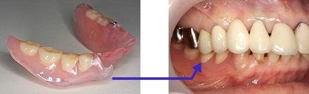 守口の新井歯科の入れ歯治療症例