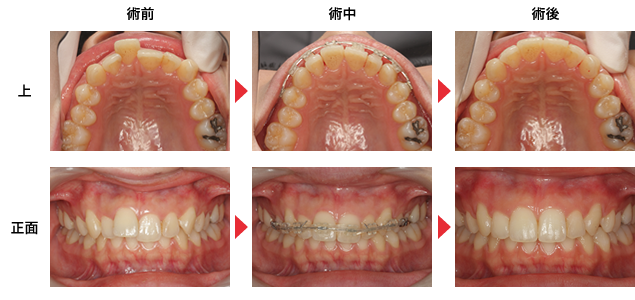 守口市の新井歯科の矯正歯科治療症例紹介1