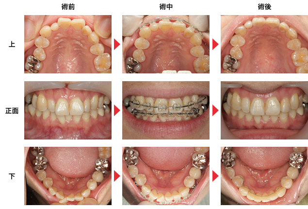 守口市の新井歯科の矯正歯科治療症例紹介2