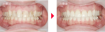守口市の新井歯科の症例紹介（オールセラミック・ホワイトニング）