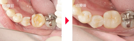 守口市の新井歯科の症例紹介（セラミックインレー）