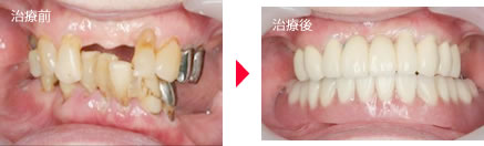 守口の新井歯科の入れ歯治療症例