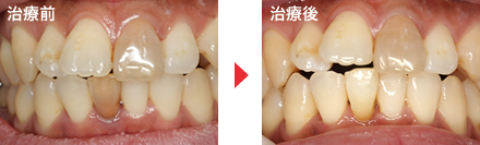 守口市の新井歯科の症例紹介・ホワイトニング（ウォーキングブリーチ）