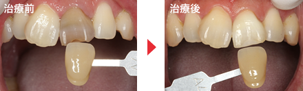 守口市の新井歯科の症例紹介・ホワイトニング（ウォーキングブリーチ）