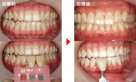 守口市の新井歯科の症例紹介（オフィスホワイトニング）