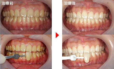 守口市の新井歯科の症例紹介（ホームホワイトニング）